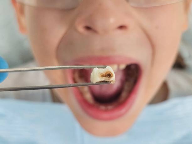 Best Root Canal Emergency Dentist  in Peppermill Village, MD